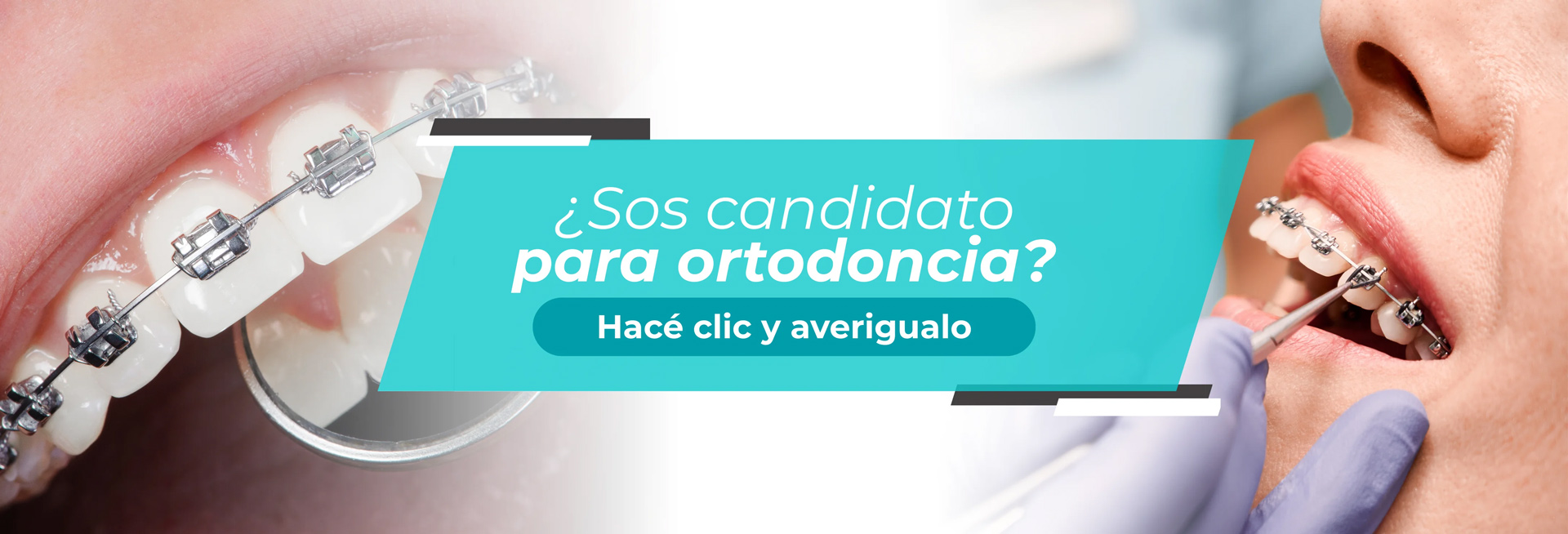 ¿Puedo usar ortodoncia?