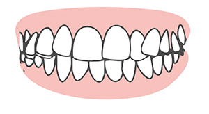 Dientes torcidos