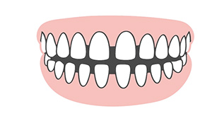 Dientes separados